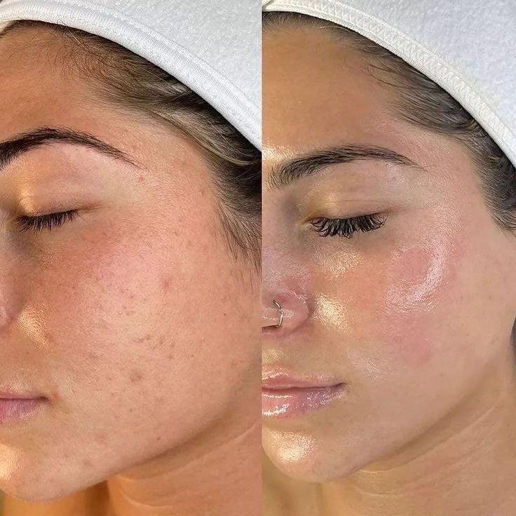 Luvanty Peel Shot Glow Rice Duo